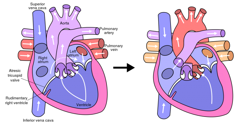 What are the Glenn and Fontan Procedures? - Hayek Medical